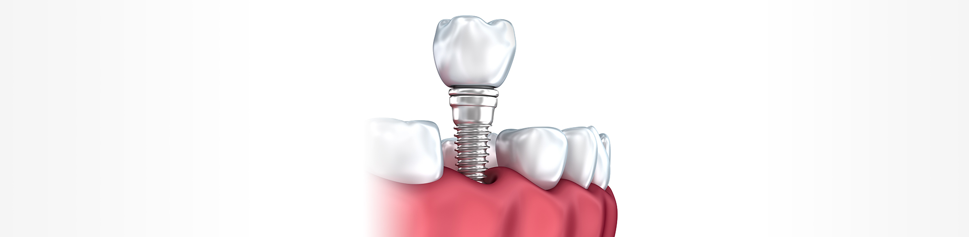 Dental Implant Singapore - TP Dental